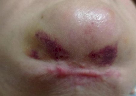 Clínica e dentistas são condenadas após cirurgias estéticas deformarem rosto em MS