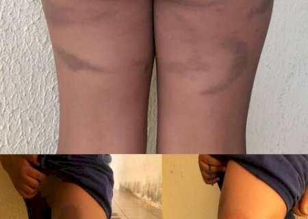 Pai &eacute; denunciado ap&oacute;s bater e entregar filho de 7 anos com hematomas &agrave; m&atilde;e