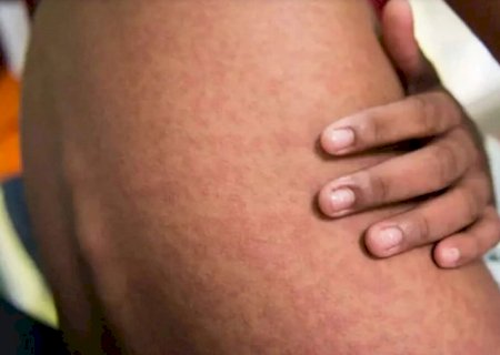 Mais da metade dos pacientes com chikungunya tem sequelas por anos: ‘É insuportável’