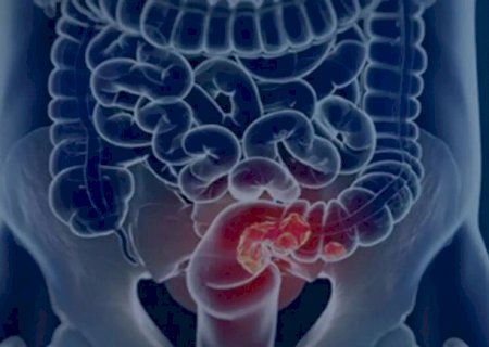 SUS adota teste de fezes para ampliar rastreio de c&acirc;ncer no intestino