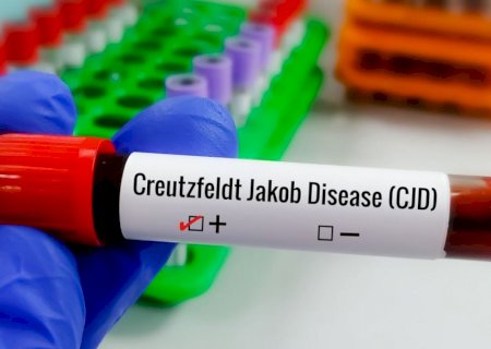 Entenda Doença de Creutzfeldt-Jakob e busca por tratamento>